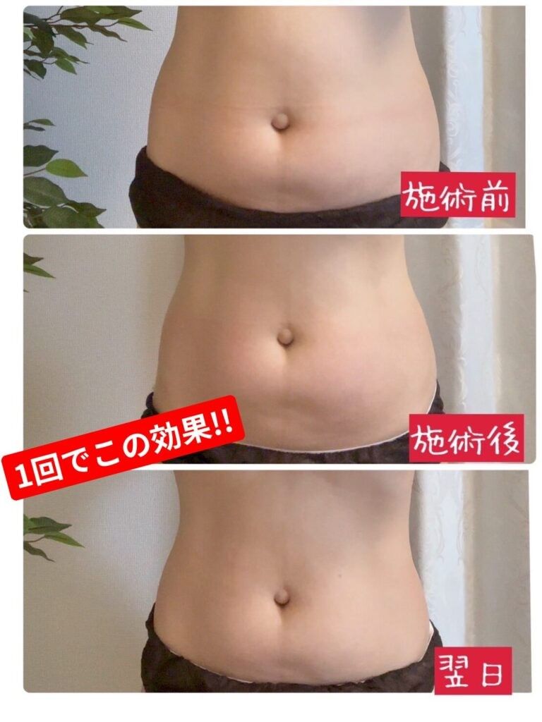 レモンボトル施術 写真2を追加