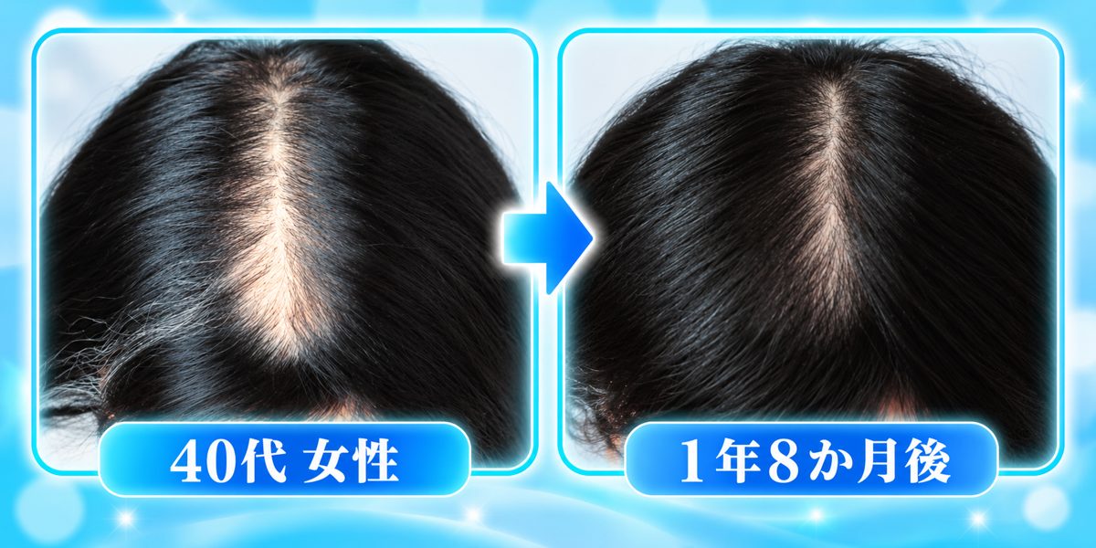 40代女性 施術前と1年8か月後