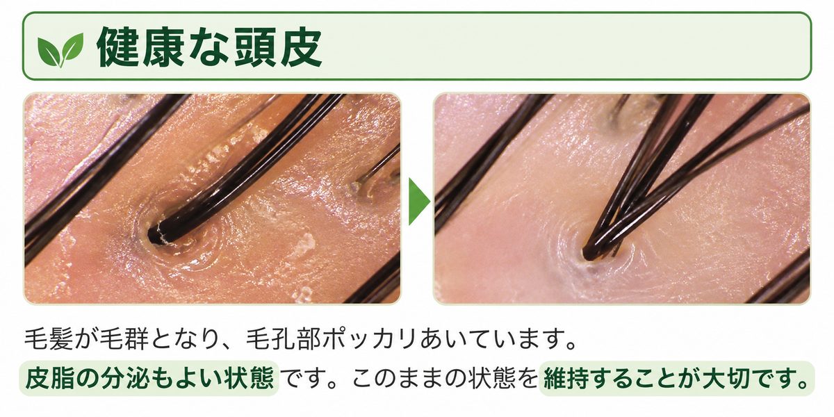 頭皮スコープで見た健康な頭皮。1つの毛穴から太い毛が数本ずつ生えている