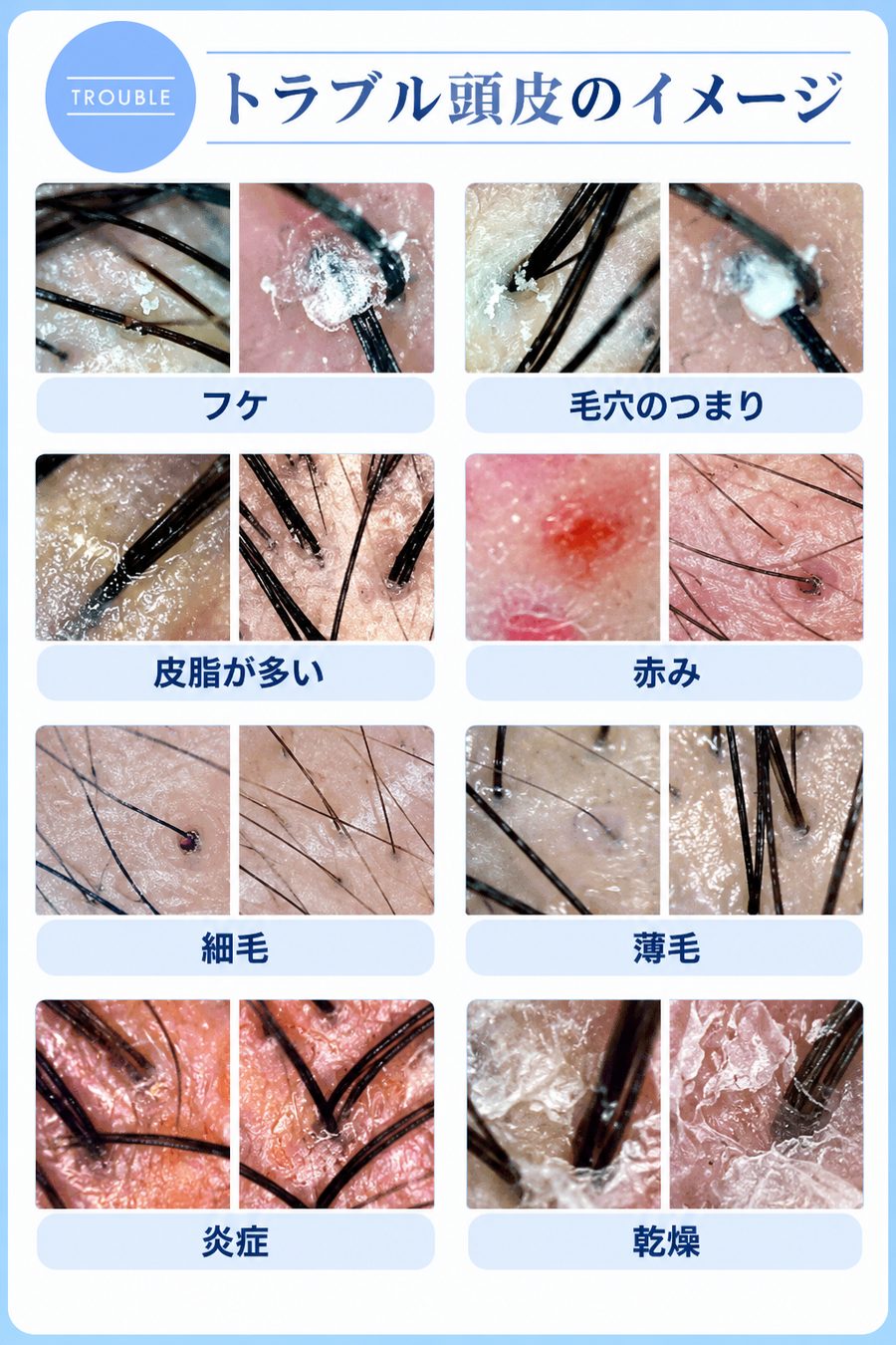 トラブル頭皮のイメージ。フケ、毛穴のつまり、皮脂が多い、赤み、細毛、薄毛、炎症、乾燥